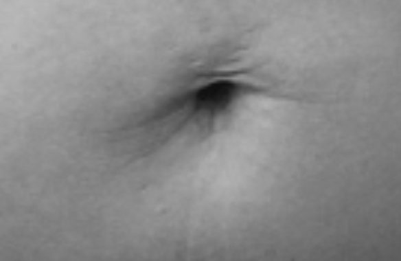 Après traitement, vergetures abdominales
