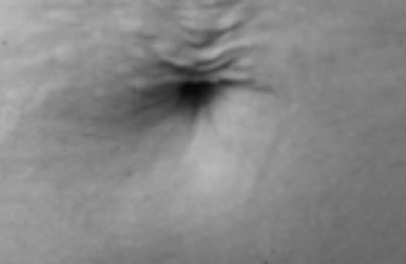 Avant traitement, vergetures abdominales