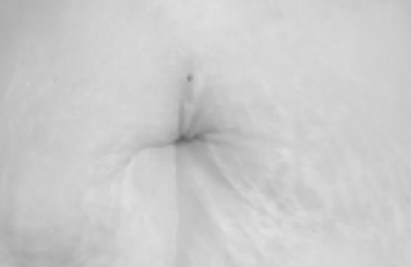 Après traitement, vergetures abdominales, ligne médiane