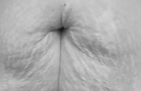 Avant traitement, vergetures abdominales, ligne médiane