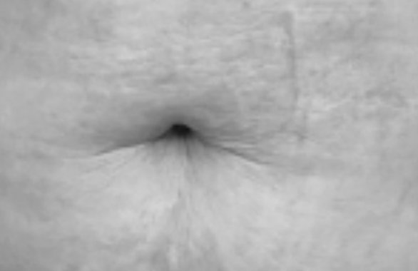 Avant traitement, vergetures sus-ombilicales